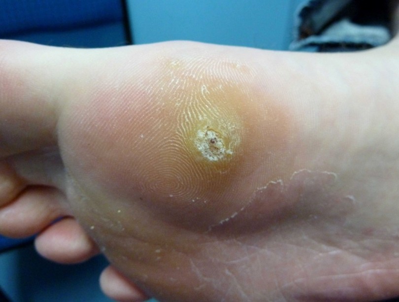 Plantar Warts Symptoms Causes Diagnosis And Treatment Natural 