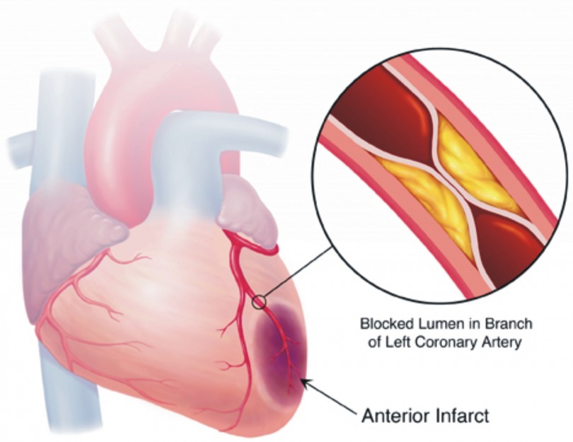 Myocardial Ischemia Causes Symptoms Diagnosis And Treatment Natural 