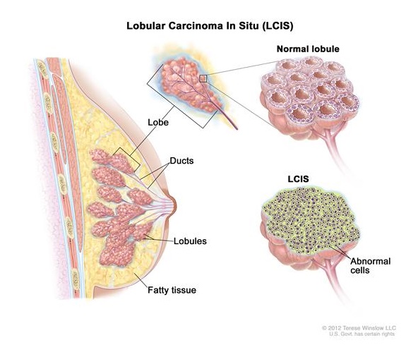 Lobular Carcinoma In Situ Lcis Causes Symptoms Diangosis And Treatment Natural Health News 