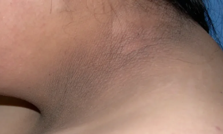 Acanthosis Nigricans