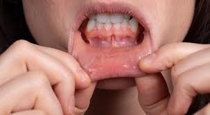 Canker Sores