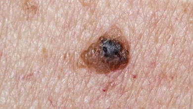 Skin Cancer