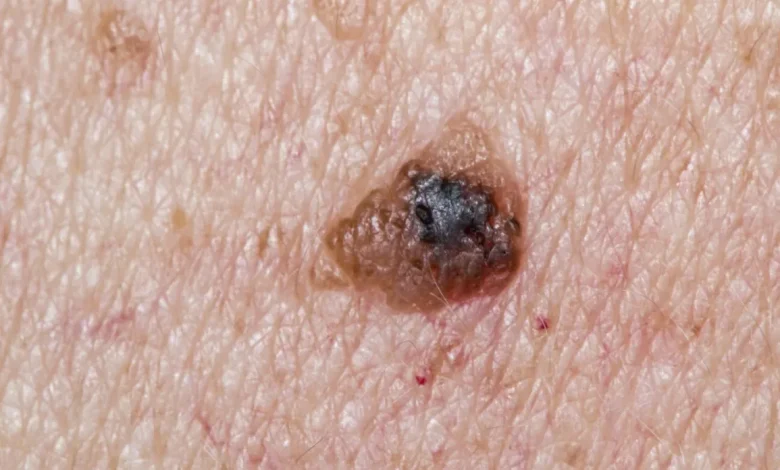 Skin Cancer