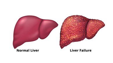 Acute Liver Failure Symptoms