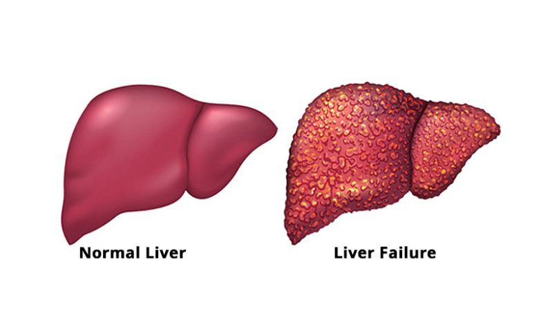 Acute Liver Failure Symptoms