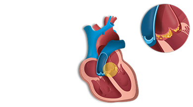 Endocarditis