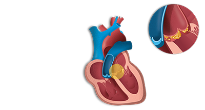 Endocarditis