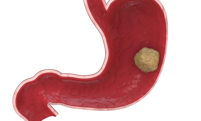 Stomach Cancer