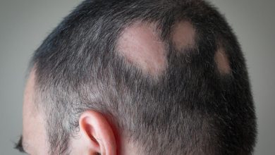 Alopecia Symptoms