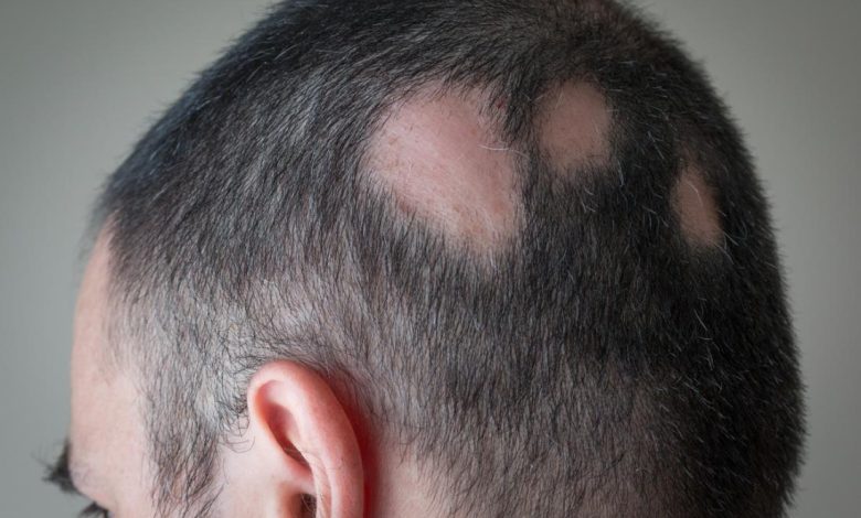 Alopecia Symptoms