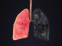 Emphysema