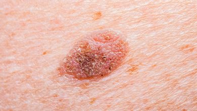 Seborrheic Keratosis