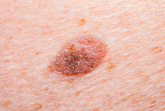 Seborrheic Keratosis