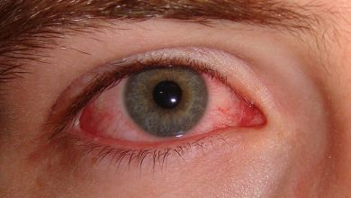 Sjogren’s Syndrome