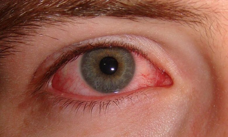 Sjogren’s Syndrome