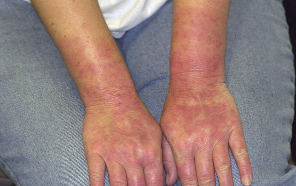 symptoms of allergy to latex mattress