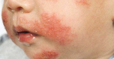 Latex Allergy Symptoms, Causes, Diagnosis and Treatment - Natural ...