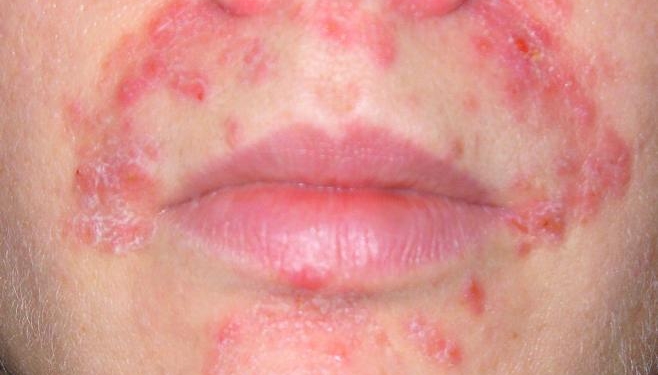 Perioral Dermatitis Symptoms, Causes, Diagnosis and Treatment | Natural ...