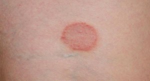 Ringworm Symptoms, Causes, Diagnosis and Treatment - Natural Health News