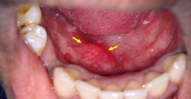 Rotavirus Symptoms, Causes, Risk Factors, Diagnosis and Treatment ...