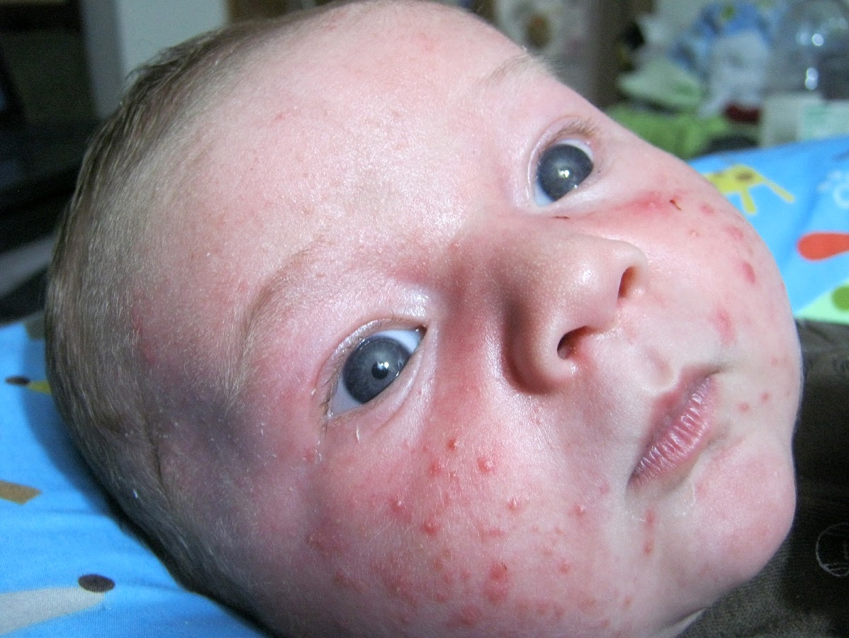 Baby Acne Symptoms, Causes, Diagnosis and Treatment
