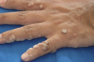 Common Warts Symptoms, Causes, Risk Factors, Diagnosis And Treatment ...