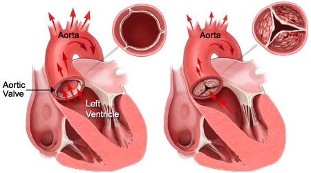 Aortic Valve Stenosis Causes, Symptoms, Diagnosis and Treatment ...