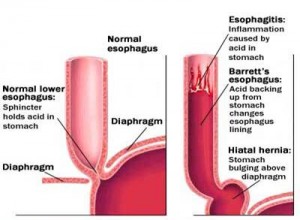  Barrett s Esophagus Causes Symptoms Diagnosis and 