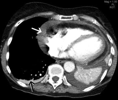 Dressler's Syndrome Causes, Symptoms, Diagnosis and Treatment - Natural ...