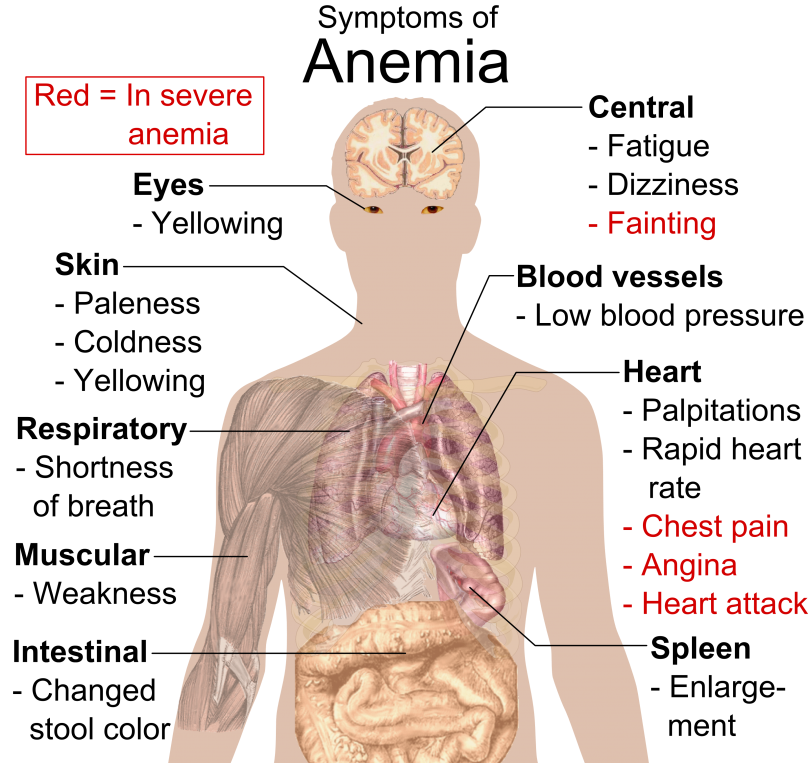 vitamin-deficiency-anemia-causes-symptoms-diagnosis-and-treatment