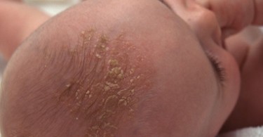 can diltiazem cause skin rash