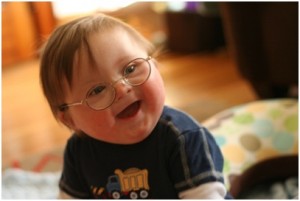 Down Syndrome Causes, Symptoms, Diagnosis And Treatment - Natural ...