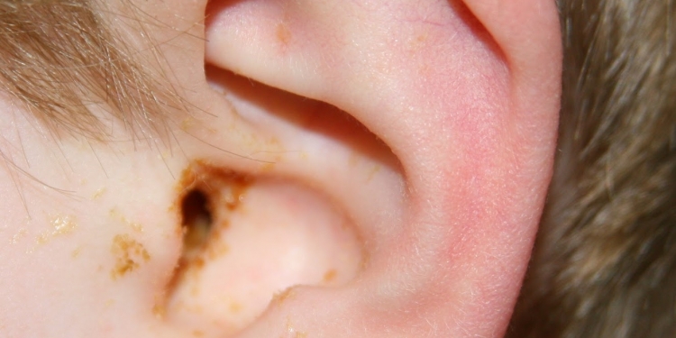 Ear Infection (Middle Ear) Causes, Symptoms, Diagnosis and Treatment ...