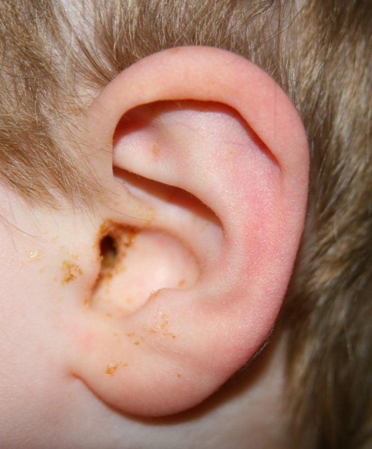 ear-infection-middle-ear-causes-symptoms-diagnosis-and-treatment