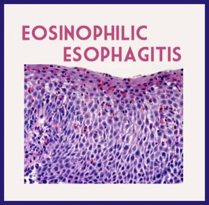 Eosinophilic Esophagitis Causes, Symptoms, Diangosis And Treatment ...