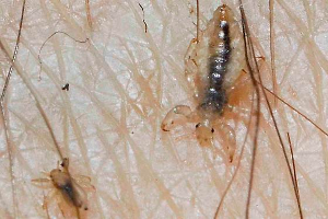 Pubic Lice Causes, Symptoms, Diangosis and Treatment | Natural Health News