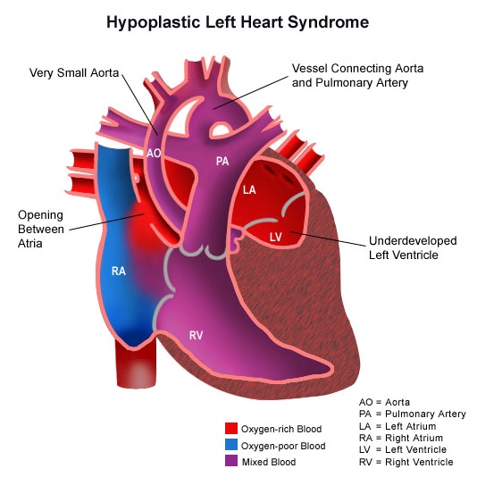 Hypoplastic Left Heart Syndrome Hlhs Causes Symptoms Diagnosis And