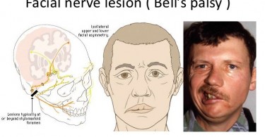 Benign Paroxysmal Positional Vertigo BPPV Causes 