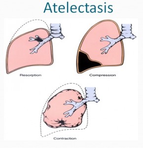 atelectasis lung pneumothorax collapsed asthma medigoo mbbs