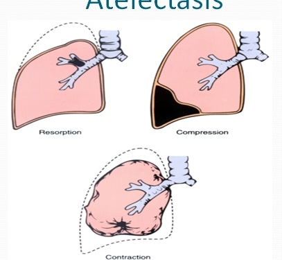 Atelectasis Causes, Symptoms, Diagnosis And Treatment | Natural Health News