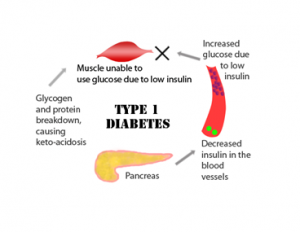 Type 1 Diabetes Causes, Symptoms, Diagnosis, Treatment - Natural Health ...