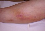 Septic Arthritis - Infectious Arthritis - Natural Health News