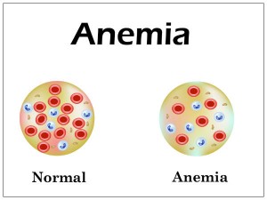 Anemia Symptoms, Causes, Diagnosis and Treatment - Natural Health News