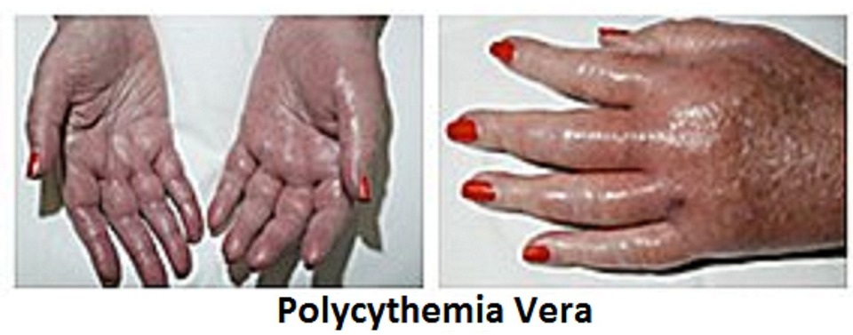 Natural Remedies for Polycythemia Vera