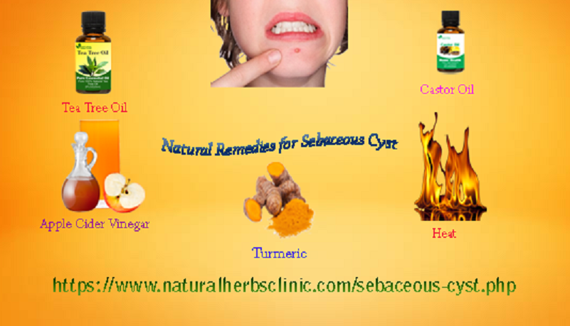 Get Rid Of Sebaceous Cyst With The Use Of 5 Natural Remedies