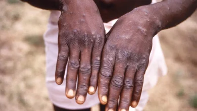 Fears new 'most dangerous' mpox strain could cross borders