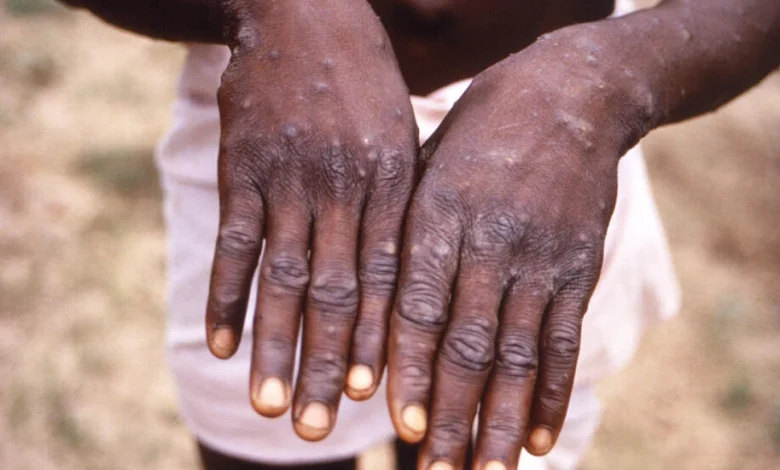 Fears new 'most dangerous' mpox strain could cross borders