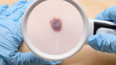 Beware of Unusual Signs of Melanoma