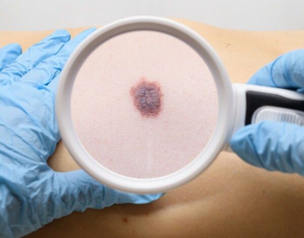 Beware of Unusual Signs of Melanoma