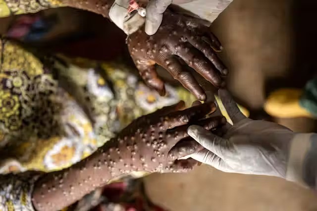 Africa desperately needs mpox vaccines